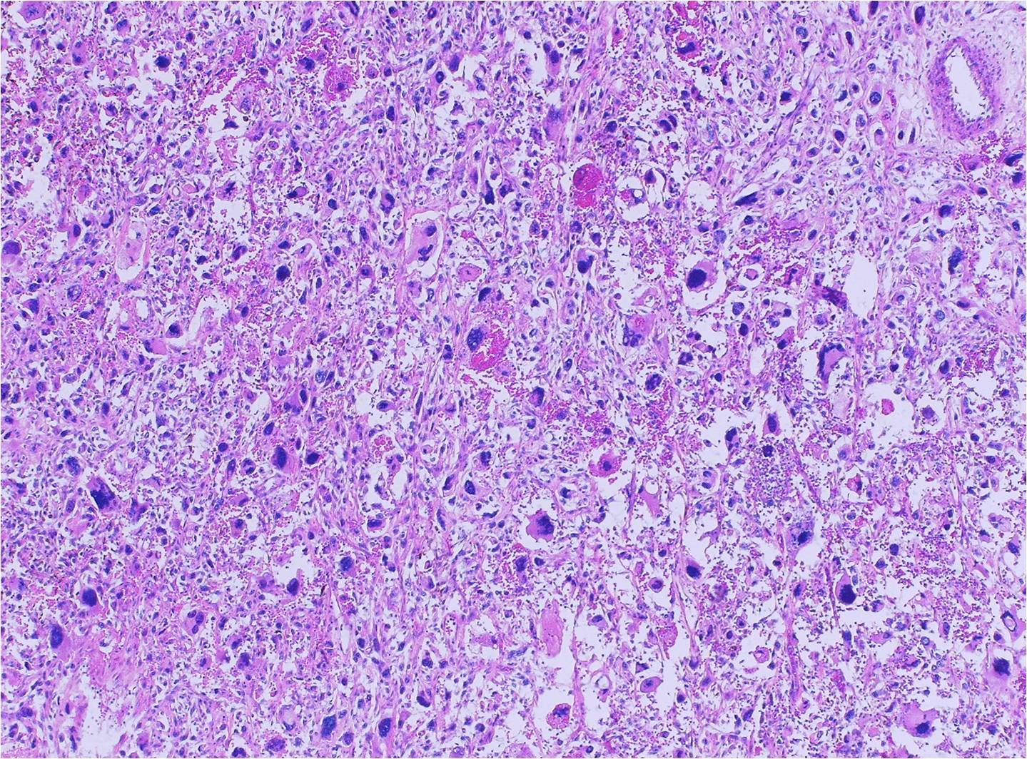Malignant Fibrous Histiocytoma (MFH) Undifferentiated Pleomorphic